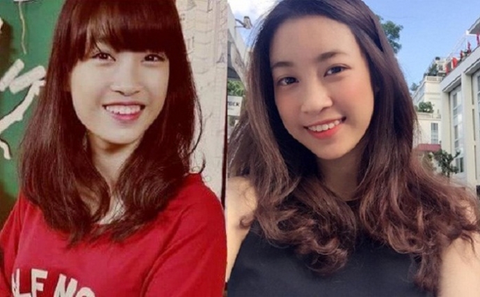 Hoa hậu Mỹ Linh bị cho l&agrave; từng đi chỉnh răng