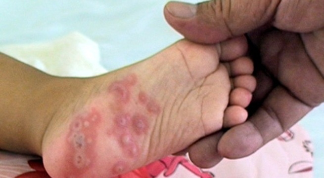 benh-tay-chan-mieng-o-tre-em-dau-hieu-cach-dieu-tr