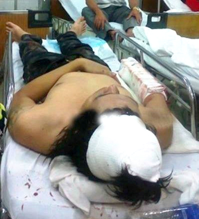 Một nạn nh&acirc;n bị thương đang cấp cứu tại bệnh viện