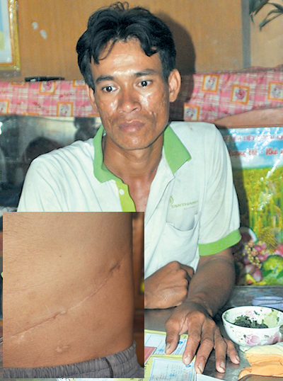 Danh Lan c&ugrave;ng vết mổ hiến thận tr&ecirc;n bụng