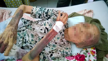 B&agrave; Bảy vết thương th&acirc;m t&iacute;m người v&igrave; con ruột đ&aacute;nh. (Ảnh: Thanh ni&ecirc;n)