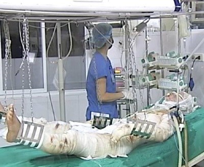 Nạn nh&acirc;n vụ m&aacute;y bay rơi ở H&ograve;a Lạc được chăm s&oacute;c tại Viện Bỏng Quốc gia. (Ảnh: TTXVN)