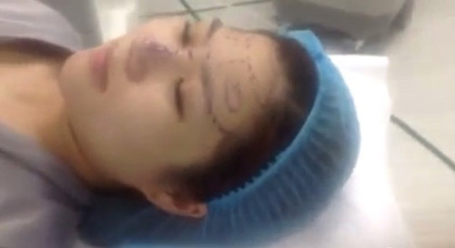 Ảnh cắt từ clip Hương Tr&agrave;m phẫu thuật thẩm mỹ