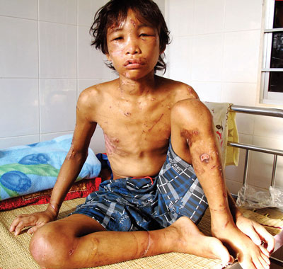 Sau khi H&agrave;o Anh bị h&agrave;nh hạ d&atilde; man, c&aacute;c tấm l&ograve;ng nh&acirc;n &aacute;i đ&atilde; hỗ trợ cho H&agrave;o Anh bằng nhiều nguồn tiền kh&aacute;c nhau