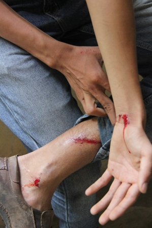 Một trong số những thương t&iacute;ch tr&ecirc;n người của một ph&oacute;ng vi&ecirc;n do bị đối tượng c&ocirc;n đồ h&agrave;nh hung