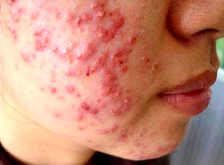 Khu&ocirc;n mặt nổi mụn v&igrave; d&ugrave;ng mỹ phẩm x&aacute;ch tay kh&ocirc;ng r&otilde; nguồn gốc của Mai