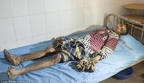 Anh phải chung sống với căn bệnh này tron