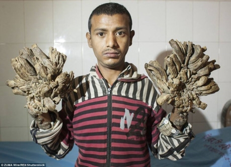 Căn bệnh khiến Abu phải từ bỏ công việ