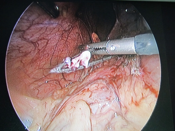 Noi- soi- lay- nhip- nho- rau- tam- tru- ca- thang