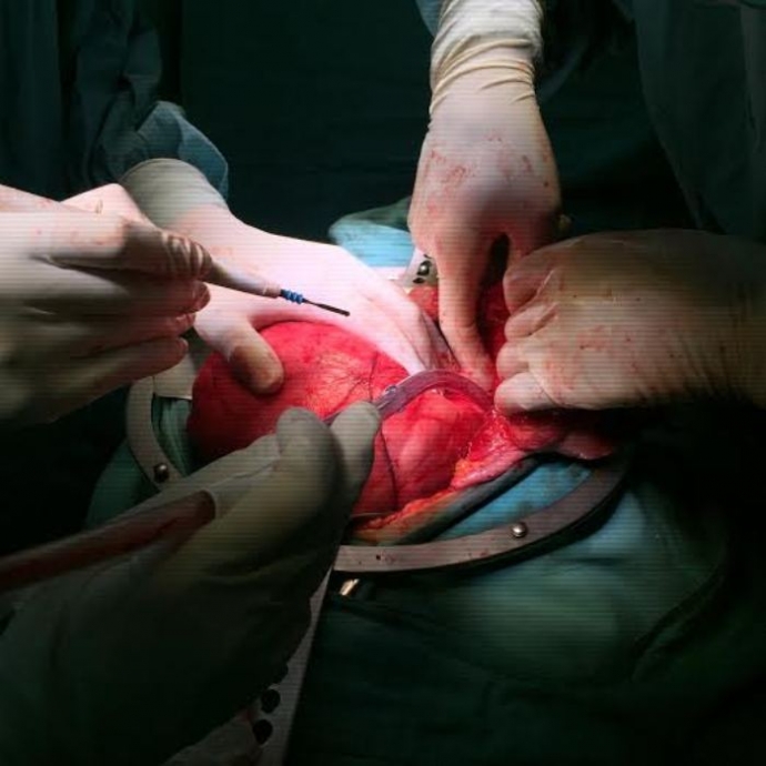 Tan- thay- khoi- u- khong- lo- hon- 6kg- lay- ra-