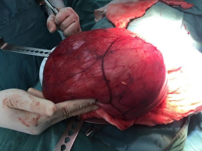 Tan- thay- khoi- u- khong- lo- hon- 6kg- lay- ra-