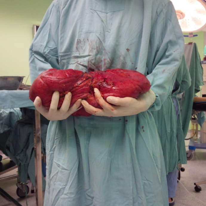 Tan- thay- khoi- u- khong- lo- hon- 6kg- lay- ra-