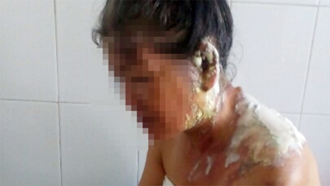 say-ruou-chong-do-nuoc-soi-vao-tai-vo-11-153248