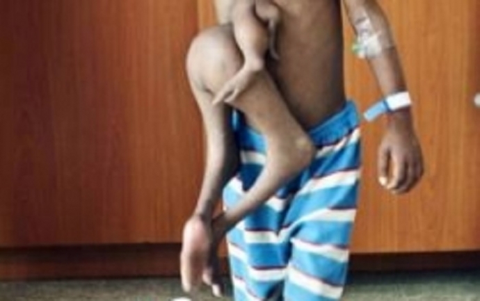 cậu b&eacute; c&oacute; 8 ch&acirc;n, tay