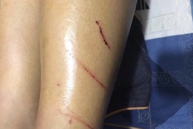 nữ sinh bị rạch đ&ugrave;i