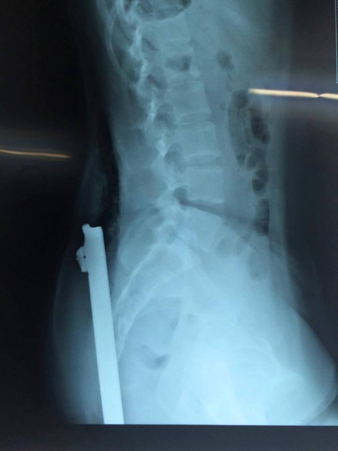 thanh-sat-dam-xuyen-nguoi1