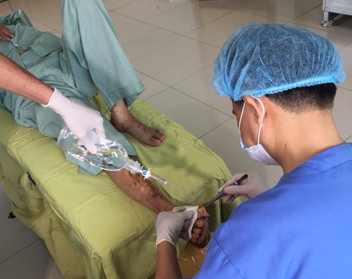 Lo&eacute;t ch&acirc;n do biến chứng đ&aacute;i th&aacute;o đường