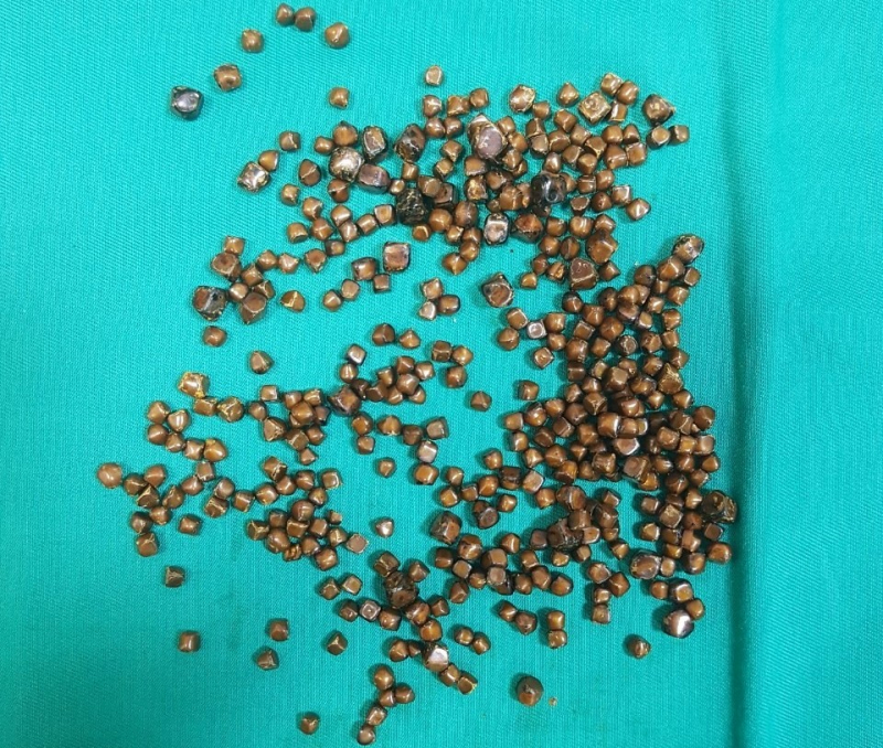 sỏi t&uacute;i mật