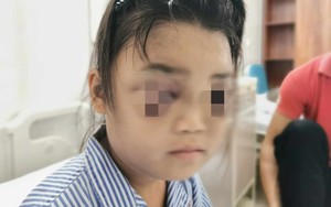 Đ&igrave;nh chỉ gi&aacute;o vi&ecirc;n d&ugrave;ng thước kẻ đ&aacute;nh sưng mắt học sinh