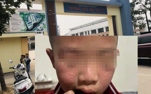 H&agrave; Nội: Nhiều học sinh mẩn ngứa v&ugrave;ng mặt, sưng mắt sau khi trường phun thuốc diệt muỗi