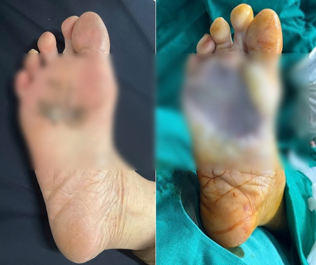 Ung thư da tiềm ẩn từ tổn thương kh&ocirc;ng đau, kh&ocirc;ng ngứa- Ảnh 1.