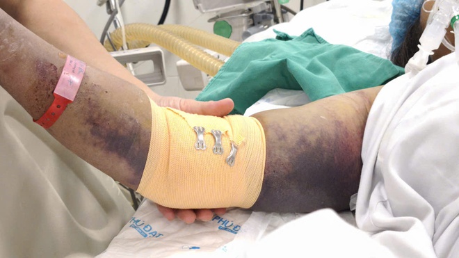 Sốt xuất huyết gia tăng sau mưa lũ, lưu &yacute; biến chứng nặng- Ảnh 3.