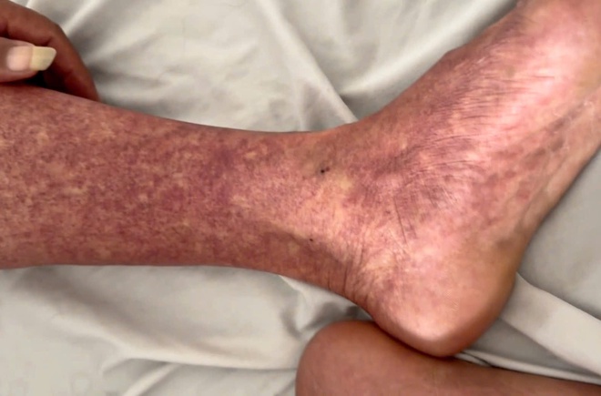 Sốt xuất huyết gia tăng sau mưa lũ, lưu &yacute; biến chứng nặng- Ảnh 2.