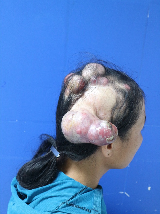 Th&oacute;t tim ca mổ cứu người phụ nữ ung thư da đầu x&acirc;m lấn xương sọ- Ảnh 1.
