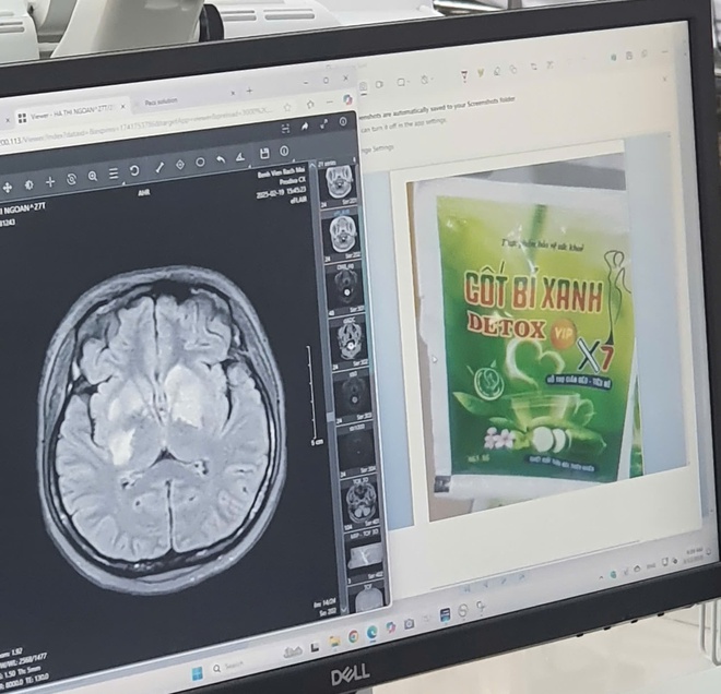 Th&ecirc;m 1 c&ocirc; g&aacute;i bị tổn thương n&atilde;o v&igrave; d&ugrave;ng sản phẩm giảm c&acirc;n chứa chất cấm- Ảnh 1.