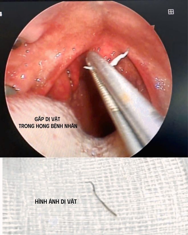 Cụ b&agrave; ho dai dẳng nhiều tuần, bất ngờ thủ phạm ẩn m&igrave;nh trong amidan- Ảnh 2.