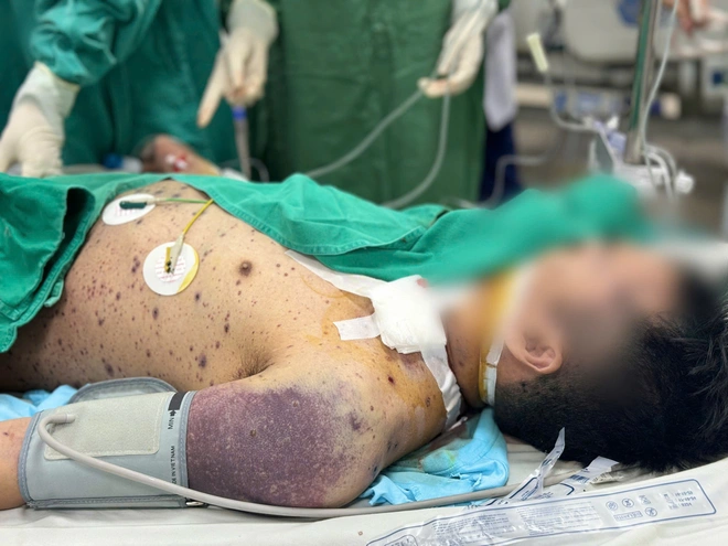 Bội nhiễm do bệnh thủy đậu "đốn ng&atilde;" thanh ni&ecirc;n khỏe mạnh- Ảnh 2.