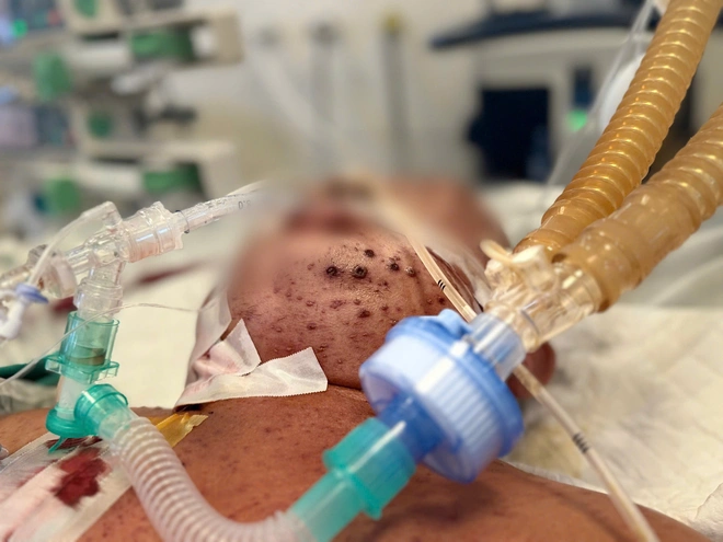 Bội nhiễm do bệnh thủy đậu "đốn ng&atilde;" thanh ni&ecirc;n khỏe mạnh- Ảnh 1.