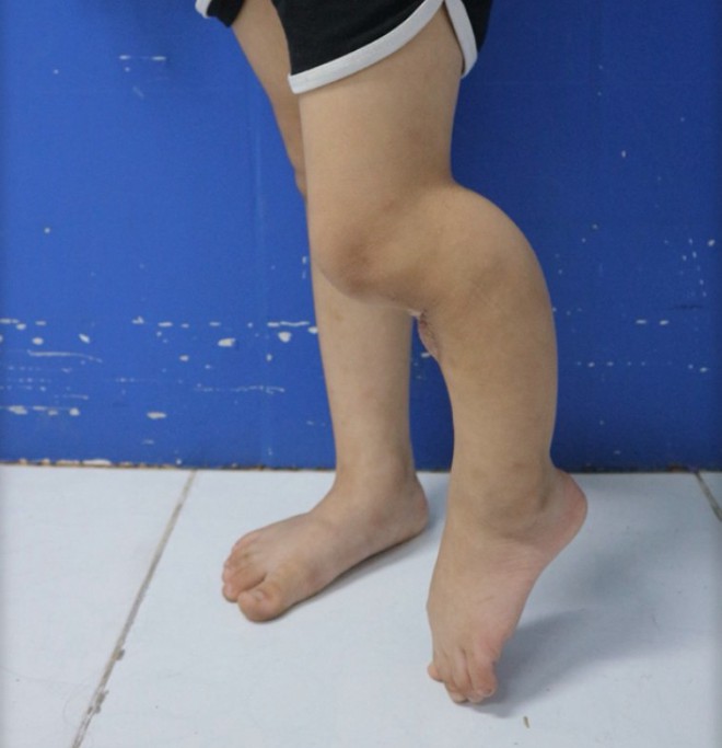 C&oacute; n&ecirc;n đắp l&aacute; chữa vi&ecirc;m xương cho trẻ?- Ảnh 1.