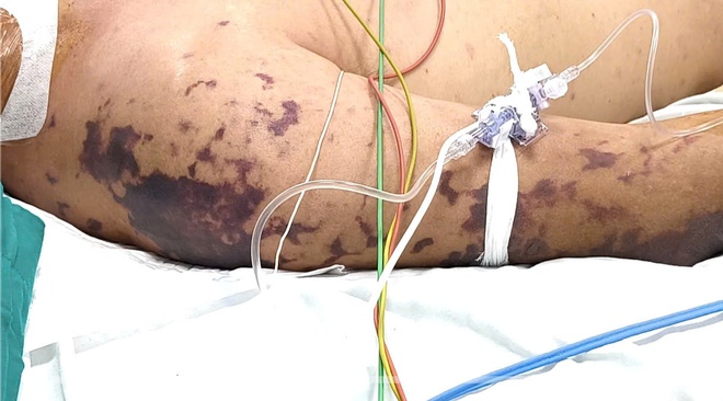 Người đ&agrave;n &ocirc;ng nguy kịch v&igrave; vi khuẩn n&atilde;o m&ocirc; cầu sau đ&aacute;m cỗ- Ảnh 2.