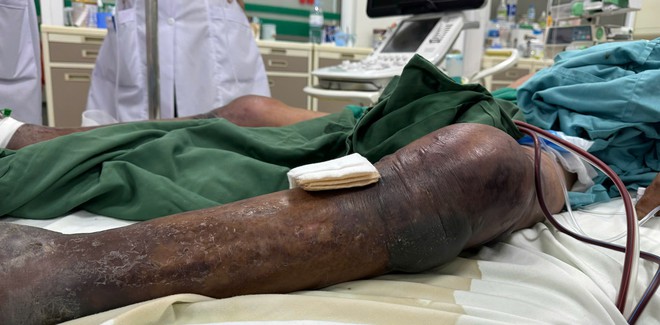 Nhiều ca sốc nhiễm khuẩn, suy đa tạng do nhiễm liên cầu lợn- Ảnh 1.