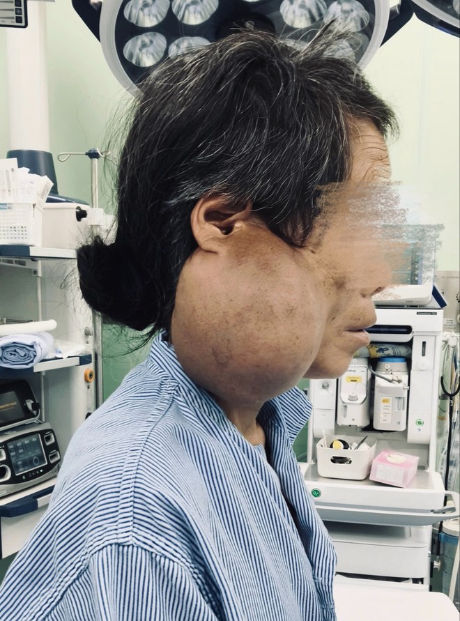 Phẫu thuật th&agrave;nh c&ocirc;ng khối u tuyến mang tai khổng lồ hơn 10cm cho 1 phụ nữ M&ocirc;ng - Ảnh 1.