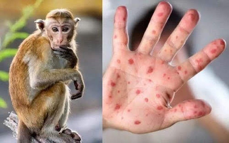 Long An: Ph&aacute;t hiện một nam thanh ni&ecirc;n dương t&iacute;nh với vi r&uacute;t đậu m&ugrave;a khỉ - Ảnh 1.