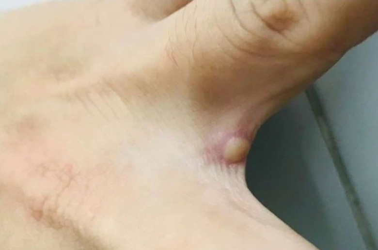 TP.HCM ghi nhận th&ecirc;m ca đậu m&ugrave;a khỉ thứ 5 ở quận T&acirc;n B&igrave;nh - Ảnh 1.