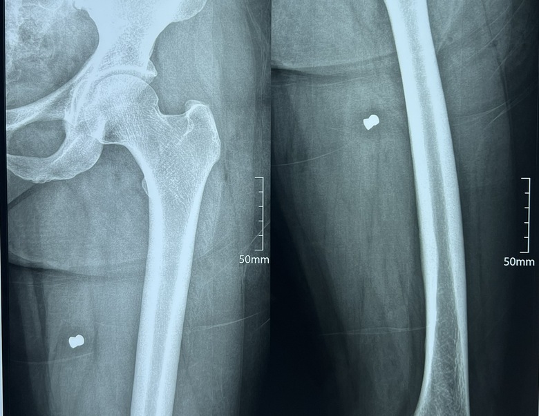 Vụ hai công nhân môi trường bị bắn: Phẫu thuật lấy ra nhiều kim khí có hình giống đầu đạn - Ảnh 3. Vụ hai công nhân môi trường bị bắn: Phẫu thuật lấy ra nhiều kim khí có hình giống đầu đạn - Ảnh 3.