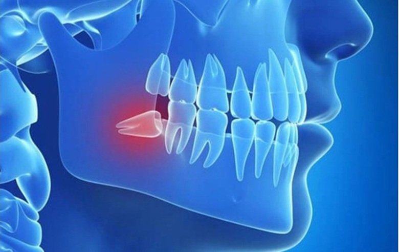 Răng số 8 mọc lệch kh&ocirc;ng đau, c&oacute; n&ecirc;n nhổ? - Ảnh 1.
