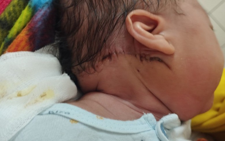 Loại bỏ khối u m&aacute;u hiếm gặp cho bệnh nhi 14 ng&agrave;y tuổi