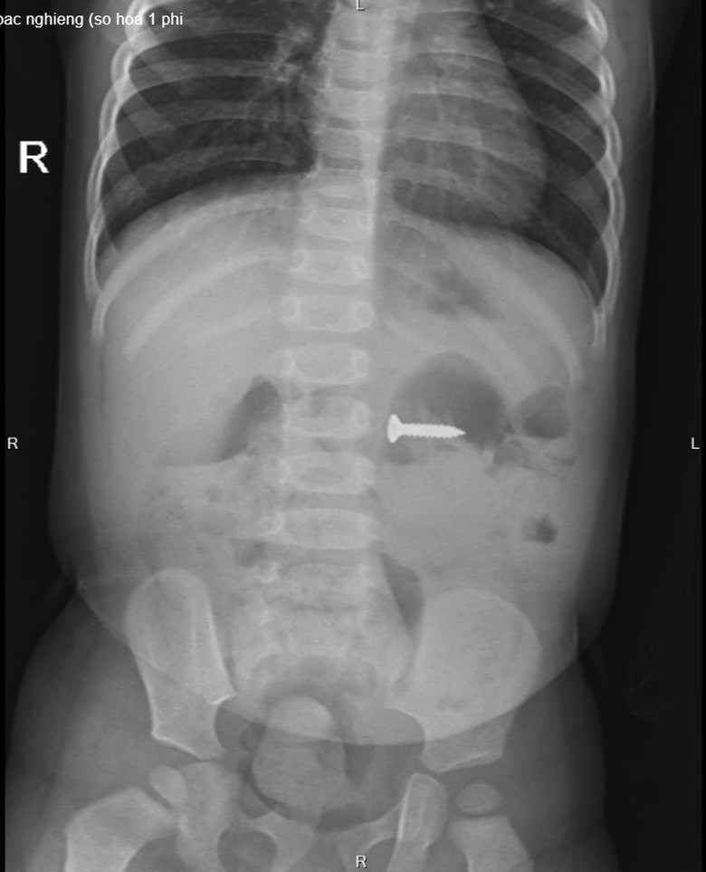 Gắp đinh v&iacute;t sắc nhọn trong bụng b&eacute; g&aacute;i 2 tuổi - Ảnh 2.