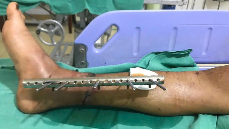 Nối th&agrave;nh c&ocirc;ng b&agrave;n ch&acirc;n đứt l&igrave;a cho nam thanh ni&ecirc;n bị TNGT   - Ảnh 1.