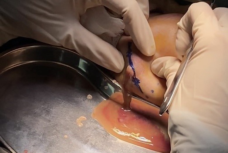 Nặn đầy dịch mủ từ ổ áp xe má cho cô gái ham tiêm filler làm đẹp - Ảnh 2. Nặn đầy dịch mủ từ ổ áp xe má cho cô gái ham tiêm filler làm đẹp - Ảnh 2.