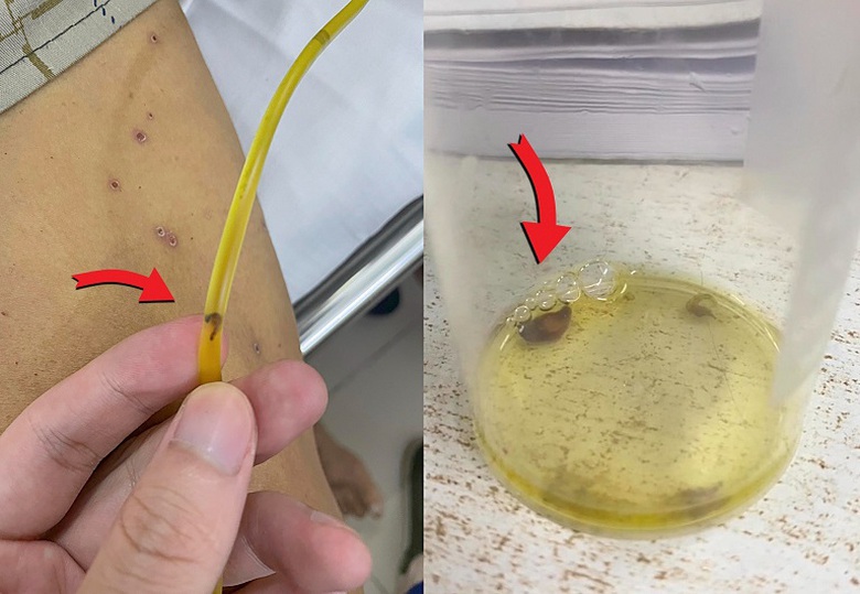 Hi hữu, s&aacute;n l&aacute; gan nhỏ chui ra từ ống dẫn lưu đường mật   - Ảnh 1.