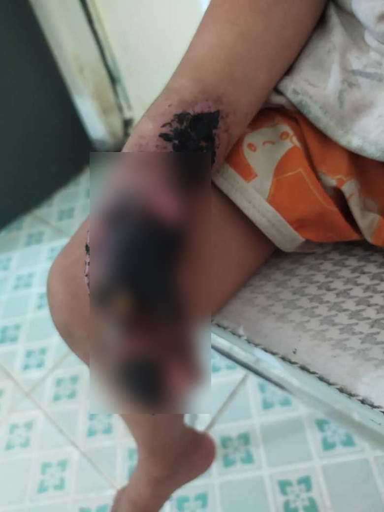 B&eacute; trai 3 tuổi nhập viện trong t&igrave;nh trạng chấn thương nặng b&agrave;n tay phải do bị điện giật - Ảnh 1.