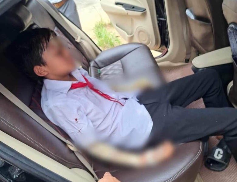 Sức khỏe 7 học sinh bị bỏng do nổ b&oacute;ng trong ng&agrave;y khai giảng ra sao? - Ảnh 1.