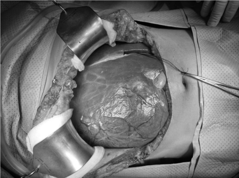 Cứu sống c&ocirc; g&aacute;i mang khối u gan khổng lồ hiếm gặp nặng 3kg- Ảnh 1.