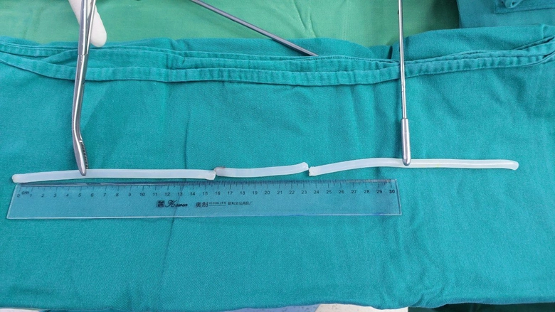 Cảnh báo rối loạn hành vi khi tự nhét dị vật vào niệu đạo- Ảnh 1. Cảnh báo rối loạn hành vi khi tự nhét dị vật vào niệu đạo- Ảnh 1.