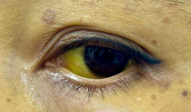 Nhiều bệnh nhân vàng da vàng mắt như nghệ nhập viện cấp cứu vì liều lĩnh làm điều này- Ảnh 2. Nhiều bệnh nhân vàng da vàng mắt như nghệ nhập viện cấp cứu vì liều lĩnh làm điều này- Ảnh 2.